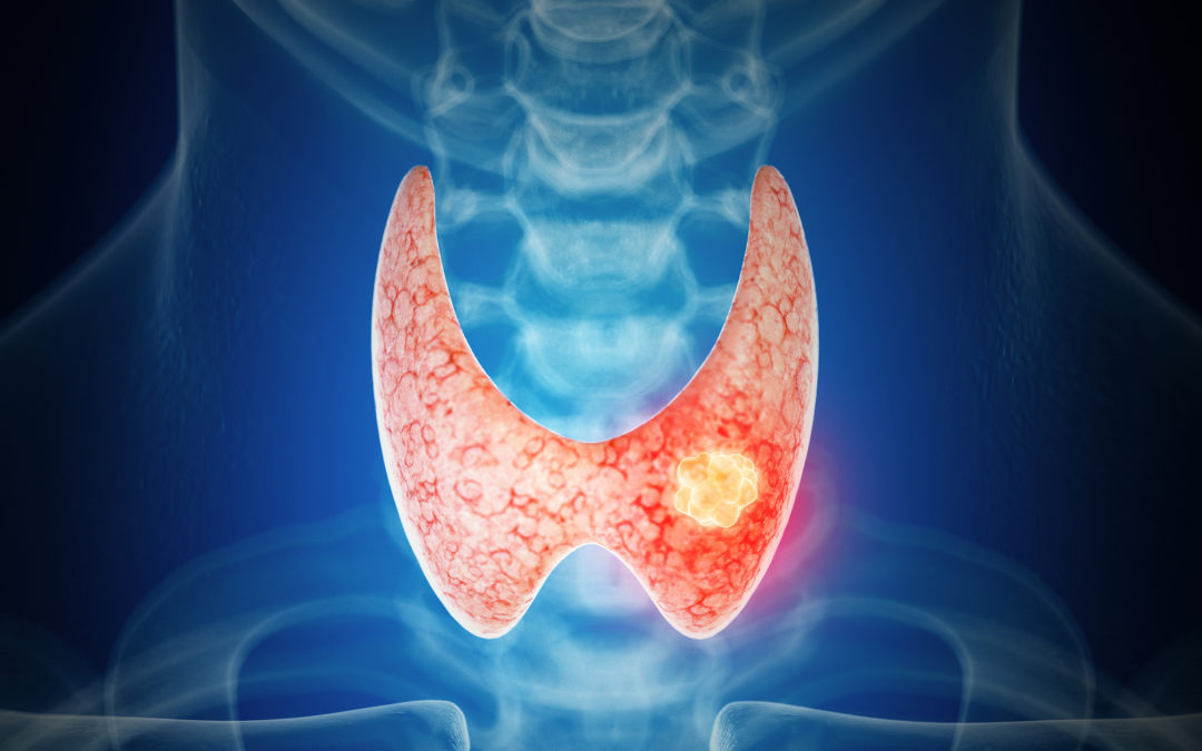 What is a thyroid nodule ablation?