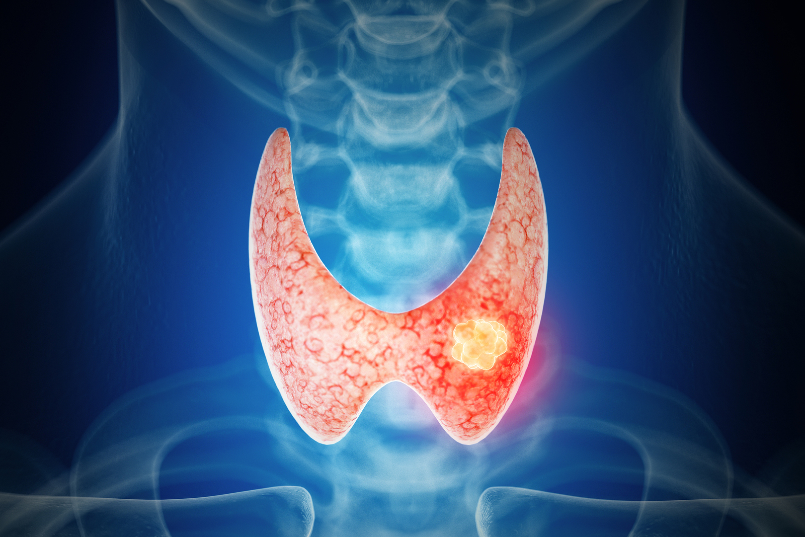 What Is A Thyroid Nodule Ablation Thyroid Clinic Utah