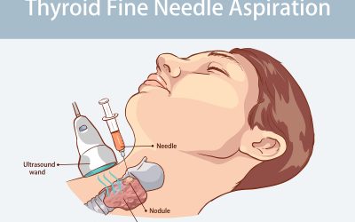 Is ultrasound guided fine needle aspiration (FNA) of the parathyroid gland safe?