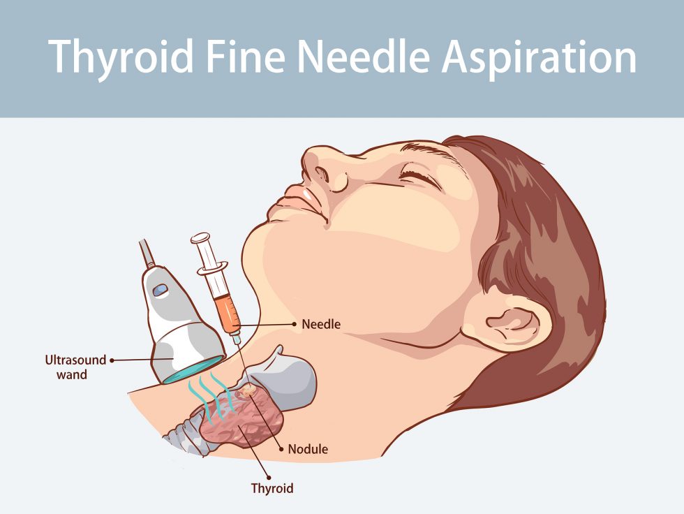 fine-needle-aspiration-cytology-preparation-procedure-results