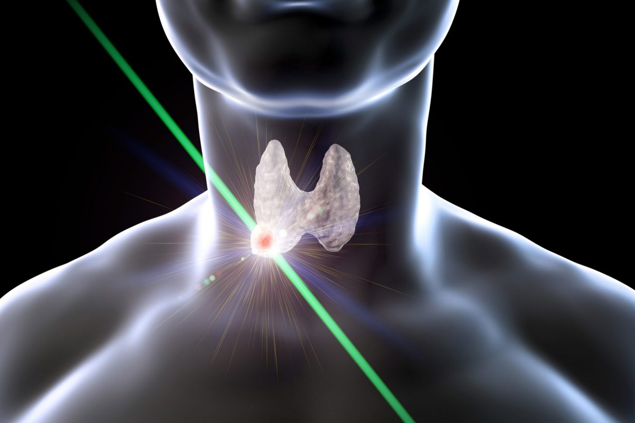 Thyroid Clinic Utah - Thyroid Radiofrequency Ablation Procedure