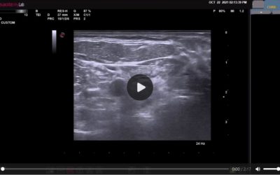 Management of Recurrent Laryngeal Nerve Injury During Radiofrequency Ablation of Thyroid Nodules