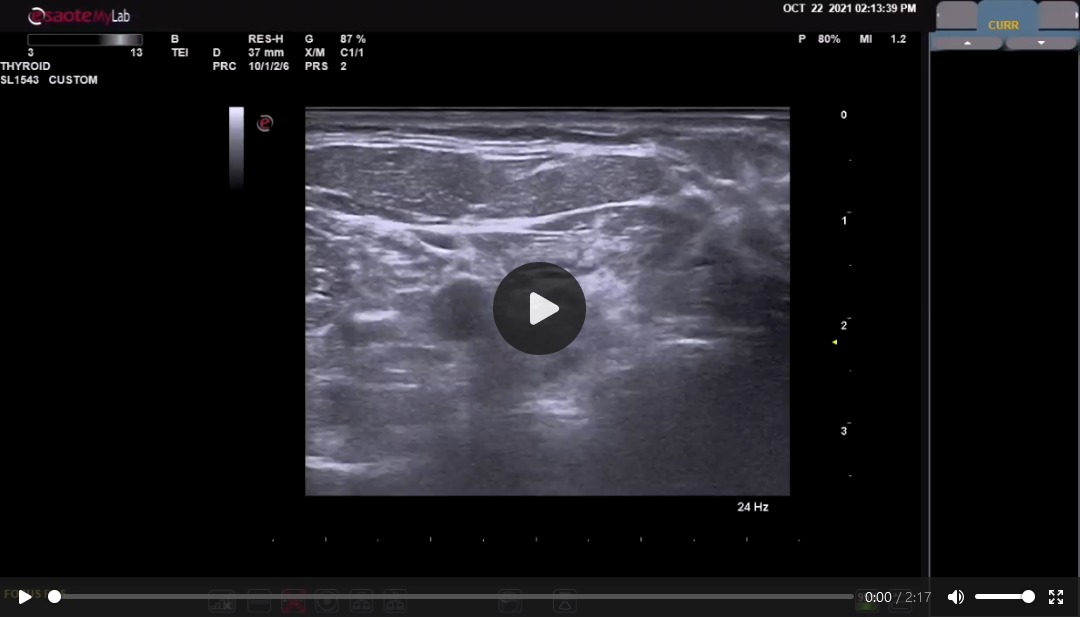 Management of Recurrent Laryngeal Nerve Injury During Radiofrequency Ablation of Thyroid Nodules